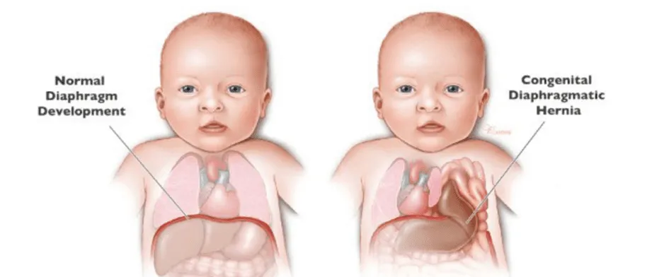 Best Diaphragmatic Hernia Surgeon in Delhi NCR